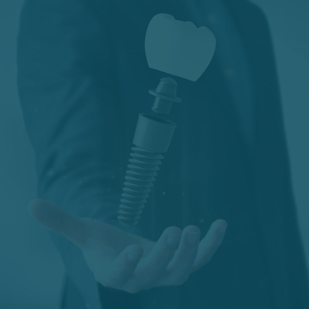 Root Canals